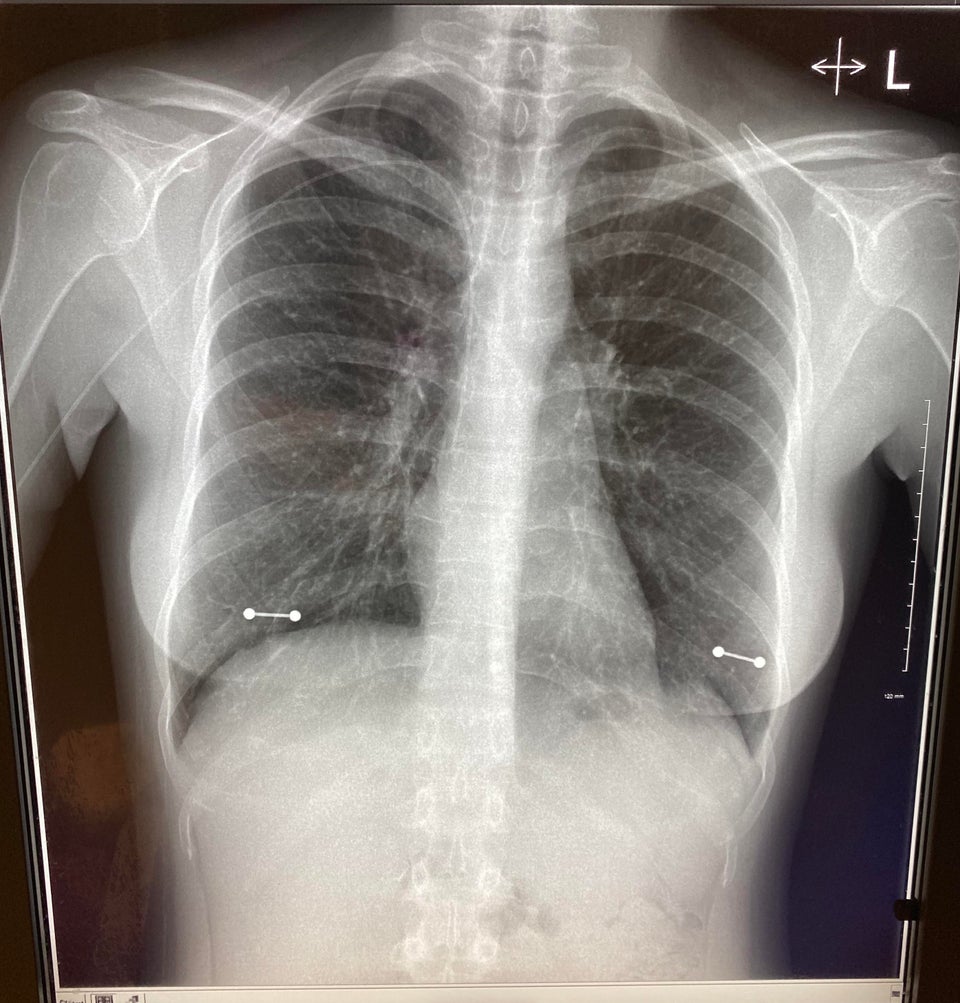 photo of an x ray of chest showing the surgical steel nipple piercings barbell.